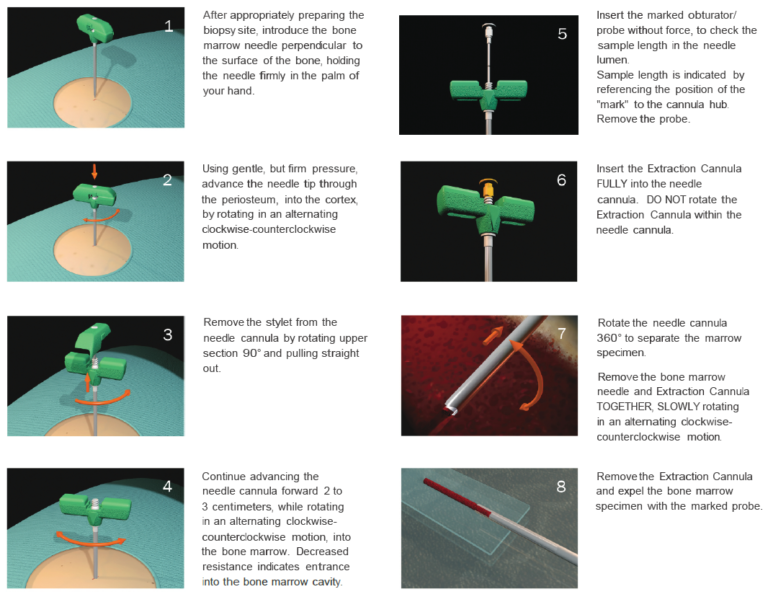 Disposable Bone Marrow Biopsy Needle In India Box Of 5 MarrowXtract disposable-bone-marrow-biopsy-needle-in-india-box-of-5-marrowxtract