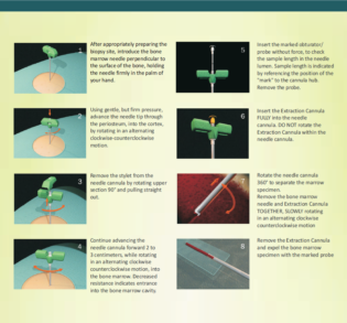 T-Handle Bone Marrow Biopsy Needles in India 8,11,13G | Surgimedex.in