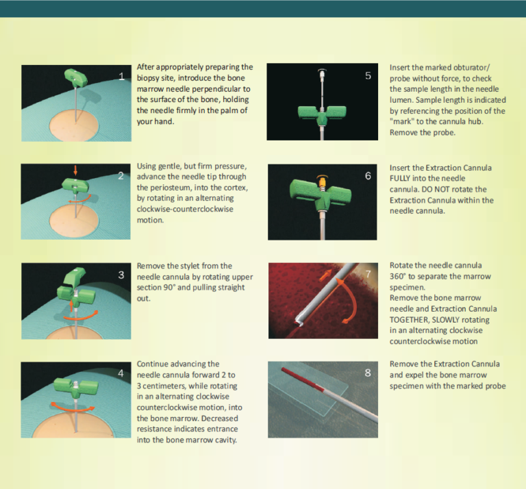 T-Handle Bone Marrow Biopsy Needles in India 8,11,13G - Surgimedex.in